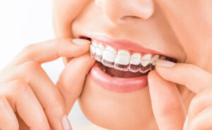 Invisalign clear aligners Hillsboro
